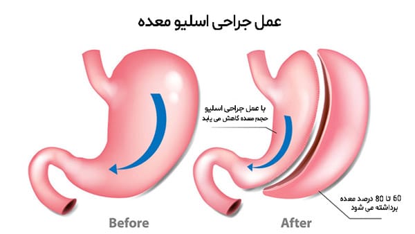 اسليو معده