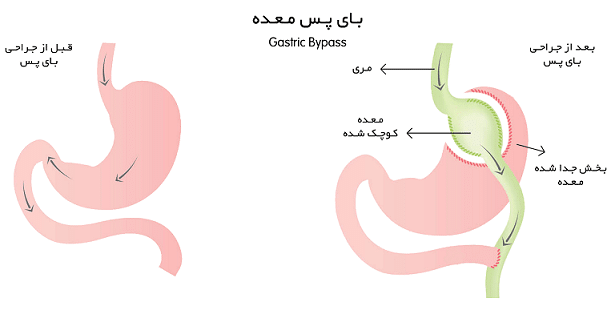 بای پس معده