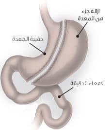 جراحات السمنة