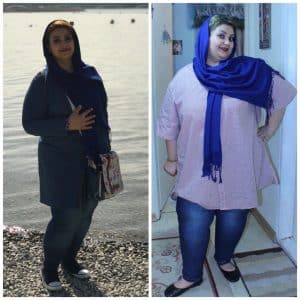 اسلیو معده